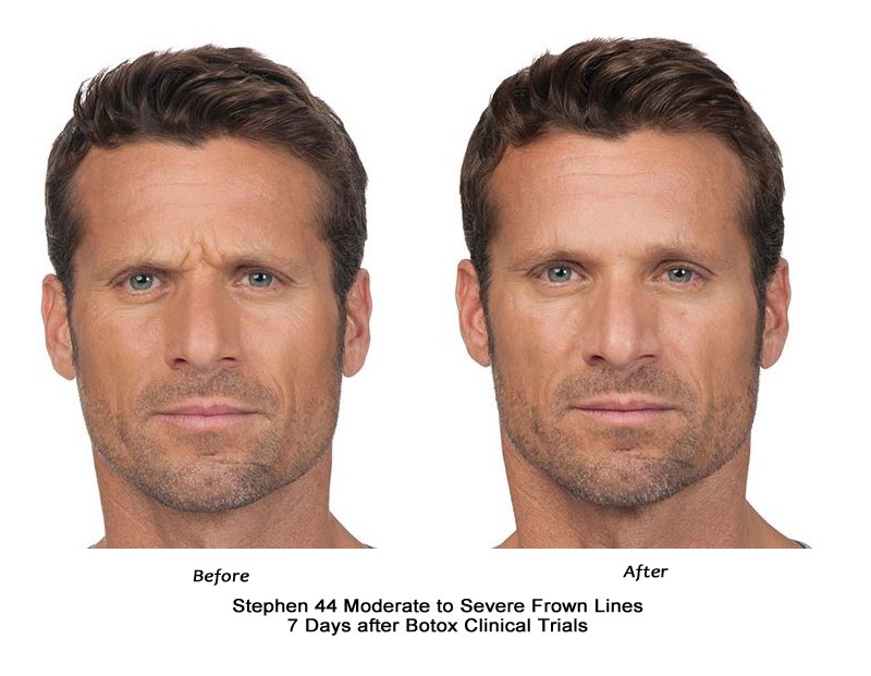 Botox for men before and after photo by Midwest Facial Plastic Surgery