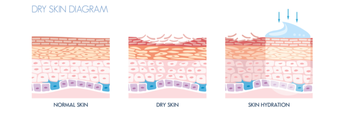 Dry skin diagram