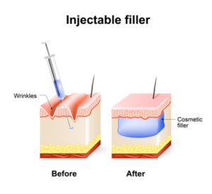 Illustration about the results of Injectable Filler