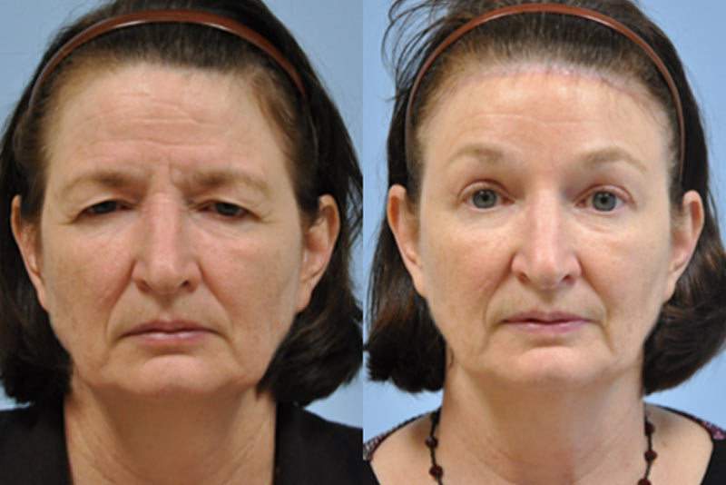 eyelid lift before and after gallery image