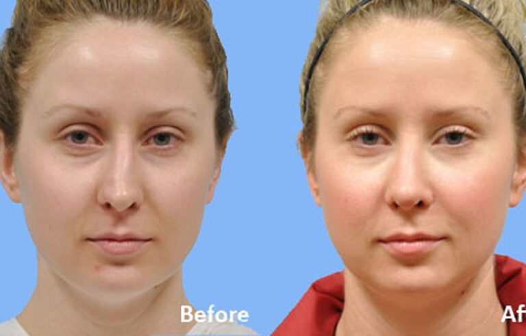 Rhinoplasty before and after photo by Midwest Facial Plastic Surgery in Minnesota