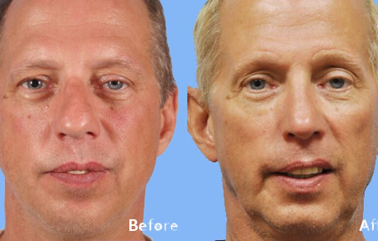 Rhinoplasty before and after photo by Midwest Facial Plastic Surgery in Minnesota