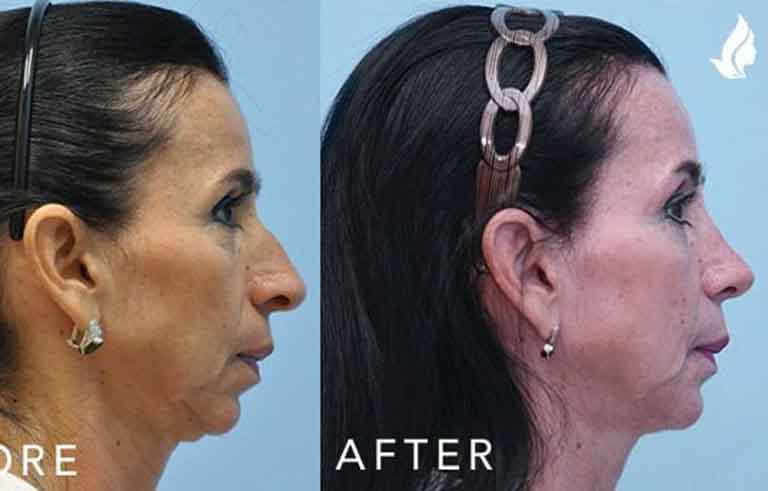 Rhinoplasty before and after photo by Midwest Facial Plastic Surgery in Minnesota