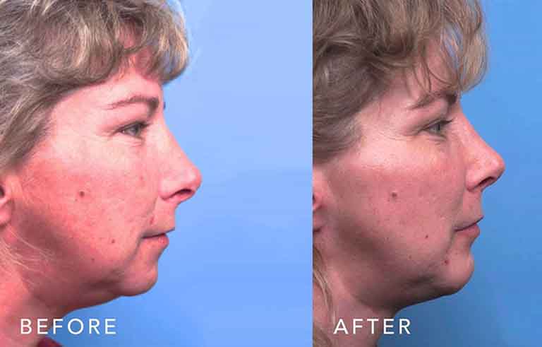 Rhinoplasty before and after photo by Midwest Facial Plastic Surgery in Minnesota