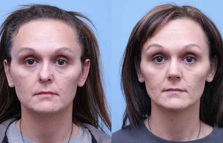 Rhinoplasty before and after photo by Midwest Facial Plastic Surgery in Minnesota