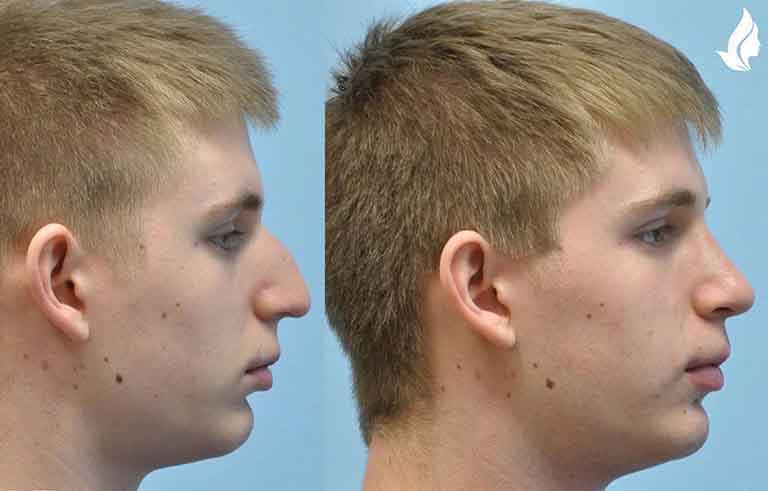 Rhinoplasty before and after photo by Midwest Facial Plastic Surgery in Minnesota