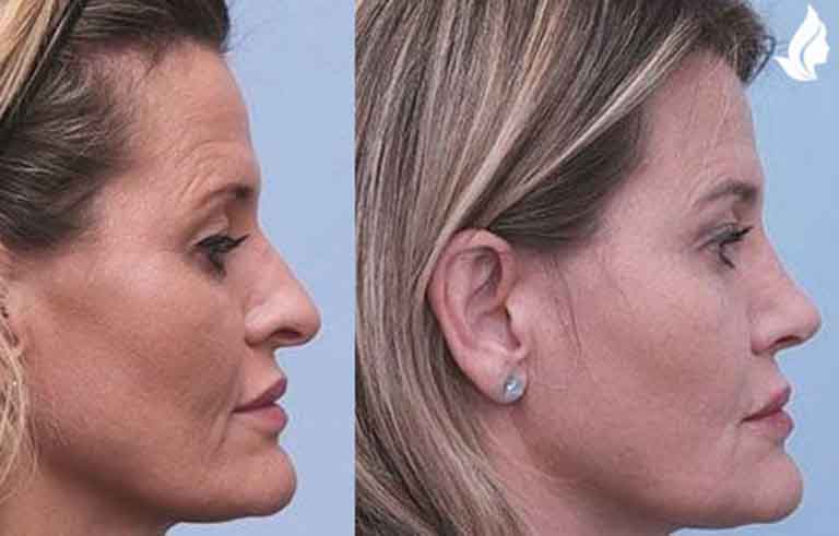 Rhinoplasty before and after photo by Midwest Facial Plastic Surgery in Minnesota