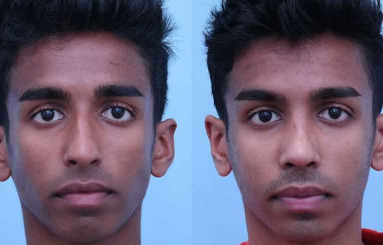 Rhinoplasty before and after photo by Midwest Facial Plastic Surgery in Minnesota