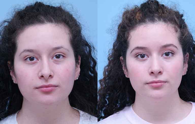 Rhinoplasty before and after photo by Midwest Facial Plastic Surgery in Minnesota