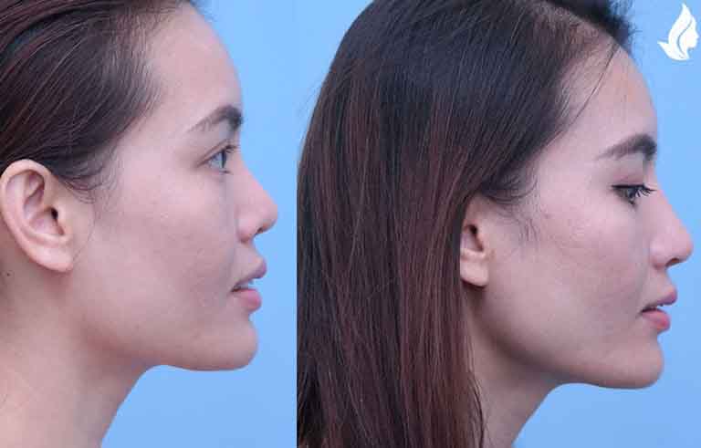 Rhinoplasty before and after photo by Midwest Facial Plastic Surgery in Minnesota