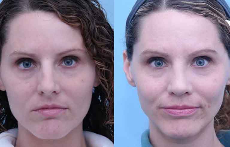 Rhinoplasty before and after photo by Midwest Facial Plastic Surgery in Minnesota