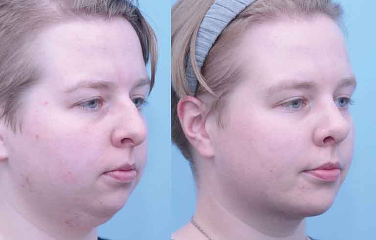 Rhinoplasty before and after photo by Midwest Facial Plastic Surgery in Minnesota