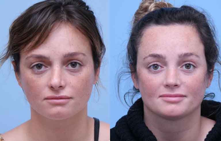 Rhinoplasty before and after photo by Midwest Facial Plastic Surgery in Minnesota