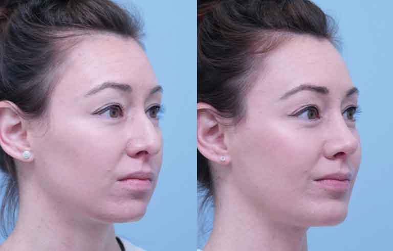 Rhinoplasty before and after photo by Midwest Facial Plastic Surgery in Minnesota