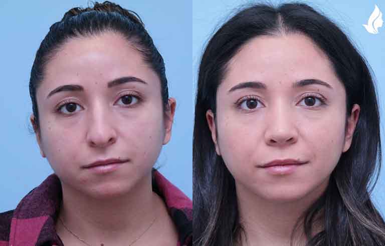 Rhinoplasty before and after photo by Midwest Facial Plastic Surgery in Minnesota