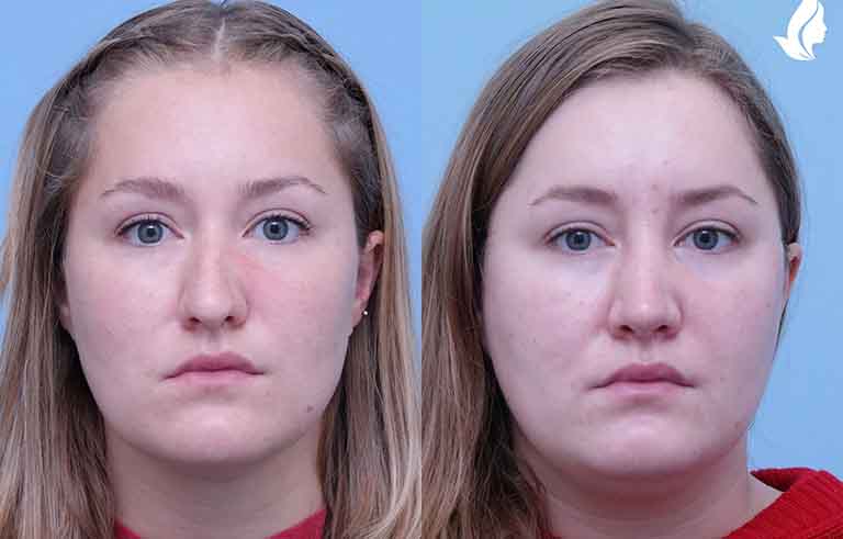 Rhinoplasty before and after photo by Midwest Facial Plastic Surgery in Minnesota