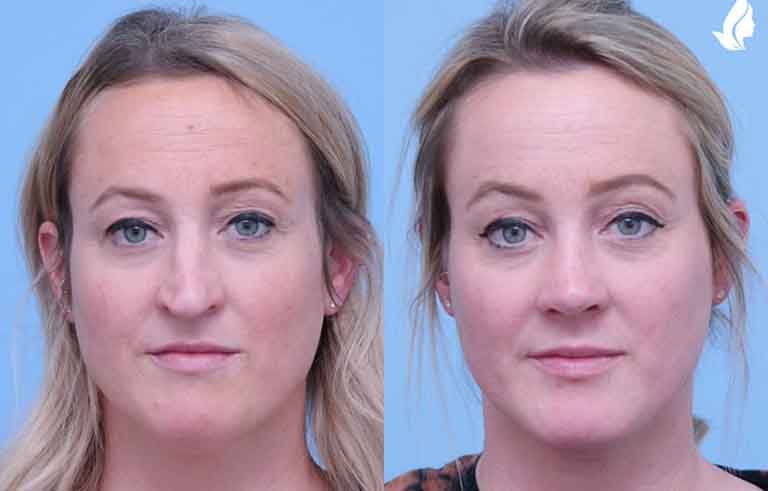 Rhinoplasty before and after photo by Midwest Facial Plastic Surgery in Minnesota