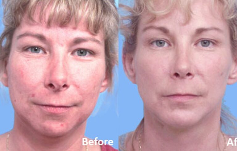 Facial Implants Chin Augmentation before and after photo by Midwest Facial Plastic Surgery in Minnesota