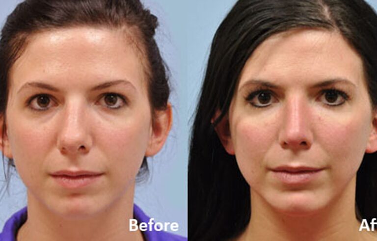 Facial Implants Chin Augmentation before and after photo by Midwest Facial Plastic Surgery in Minnesota