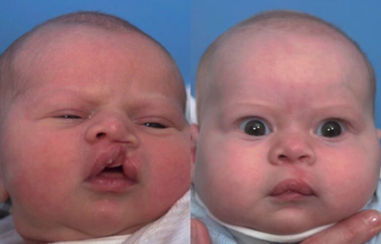 Cleft Lip Nose before and after photo by Midwest Facial Plastic Surgery in Minnesota