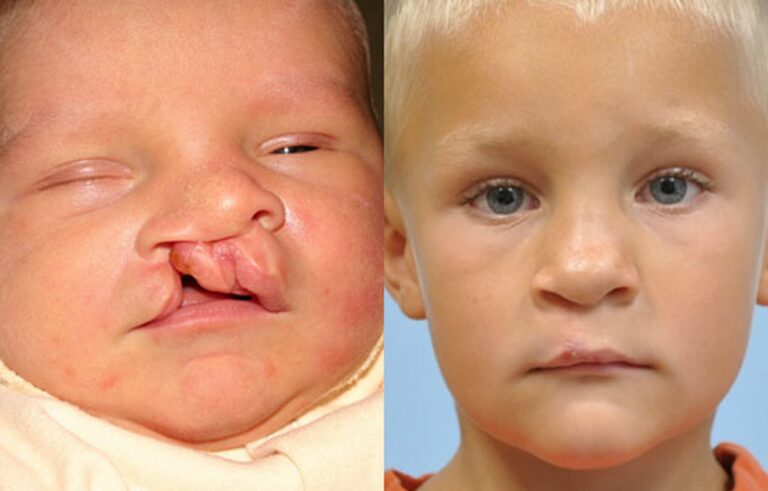 Cleft Lip Nose before and after photo by Midwest Facial Plastic Surgery in Minnesota