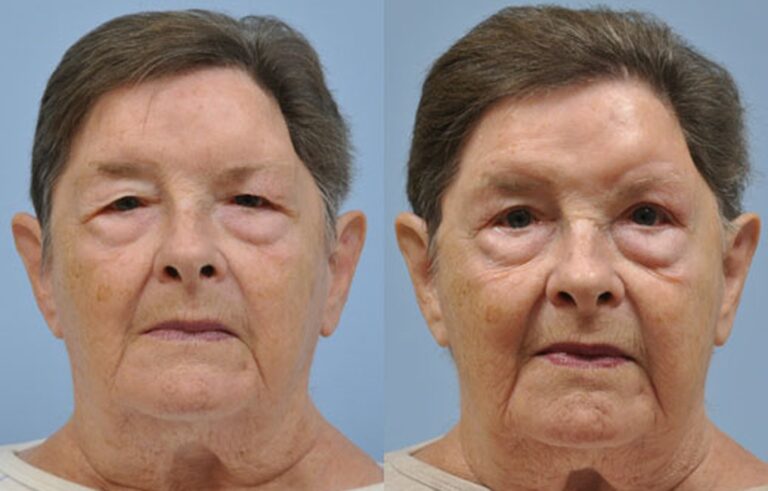 Eyelid Surgery before and after photo by Midwest Facial Plastic Surgery in Minnesota