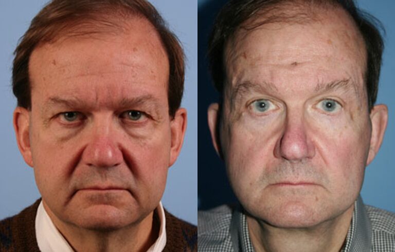 Eyelid Surgery before and after photo by Midwest Facial Plastic Surgery in Minnesota