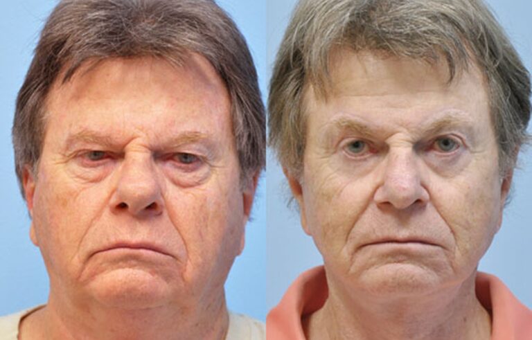 Eyelid Surgery before and after photo by Midwest Facial Plastic Surgery in Minnesota