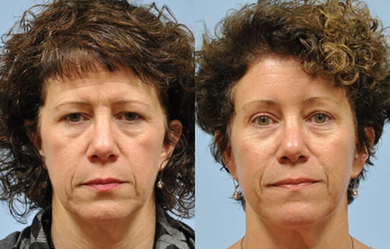 Eyelid Surgery before and after photo by Midwest Facial Plastic Surgery in Minnesota