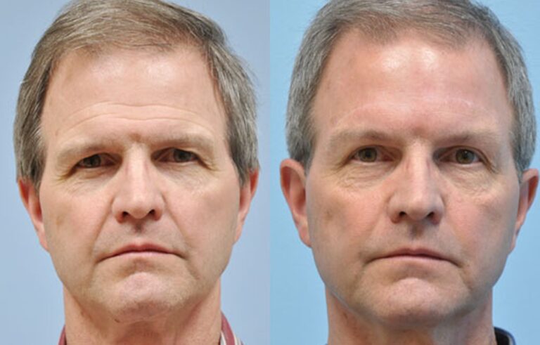 Eyelid Surgery before and after photo by Midwest Facial Plastic Surgery in Minnesota