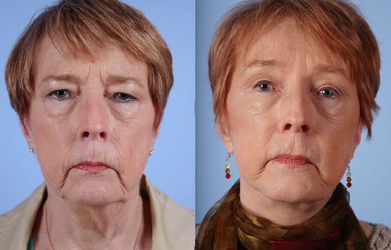 Eyelid Surgery before and after photo by Midwest Facial Plastic Surgery in Minnesota