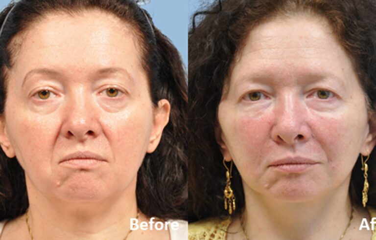 Facelift before and after photo by Midwest Facial Plastic Surgery in Minnesota