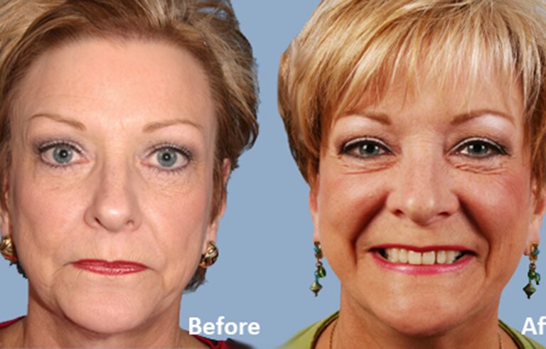 Facelift before and after photo by Midwest Facial Plastic Surgery in Minnesota