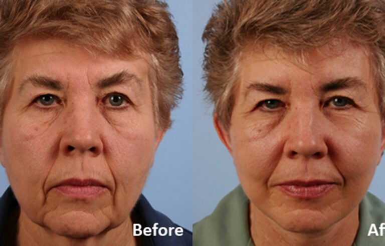 Facelift before and after photo by Midwest Facial Plastic Surgery in Minnesota