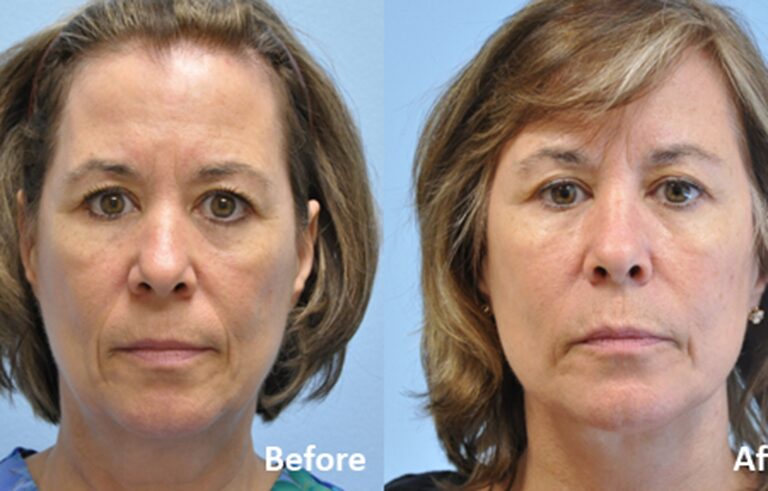 Facelift before and after photo by Midwest Facial Plastic Surgery in Minnesota