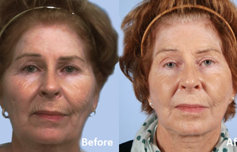 Facelift before and after photo by Midwest Facial Plastic Surgery in Minnesota