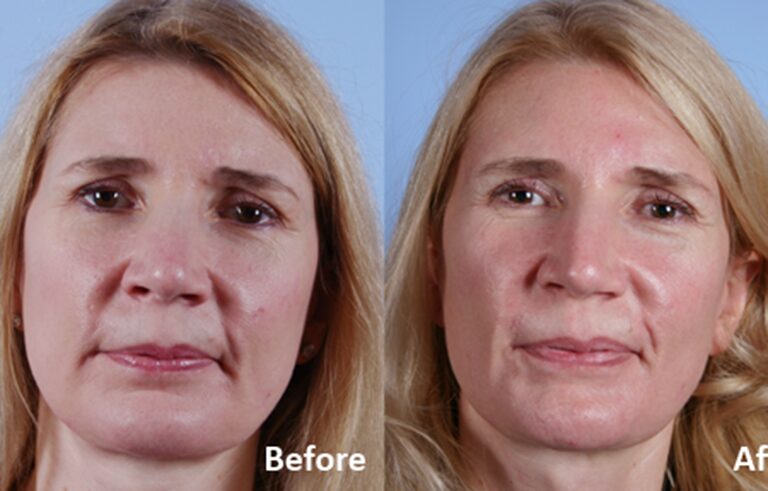 Facelift before and after photo by Midwest Facial Plastic Surgery in Minnesota