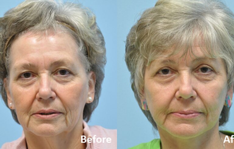 Facelift before and after photo by Midwest Facial Plastic Surgery in Minnesota