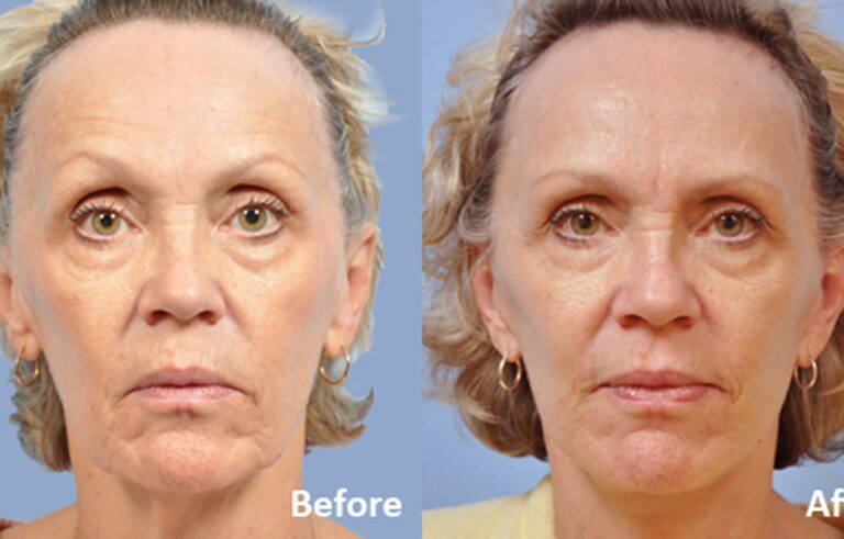 Facelift before and after photo by Midwest Facial Plastic Surgery in Minnesota