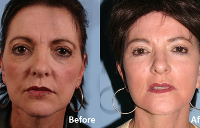 Facelift before and after photo by Midwest Facial Plastic Surgery in Minnesota