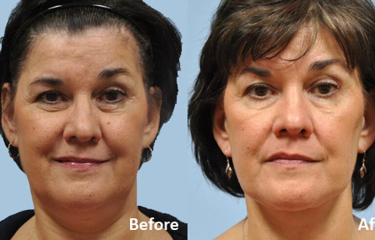 Facelift before and after photo by Midwest Facial Plastic Surgery in Minnesota