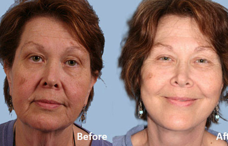 Facelift before and after photo by Midwest Facial Plastic Surgery in Minnesota