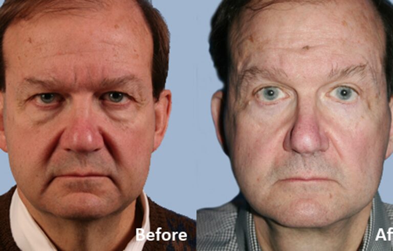 Facelift before and after photo by Midwest Facial Plastic Surgery in Minnesota