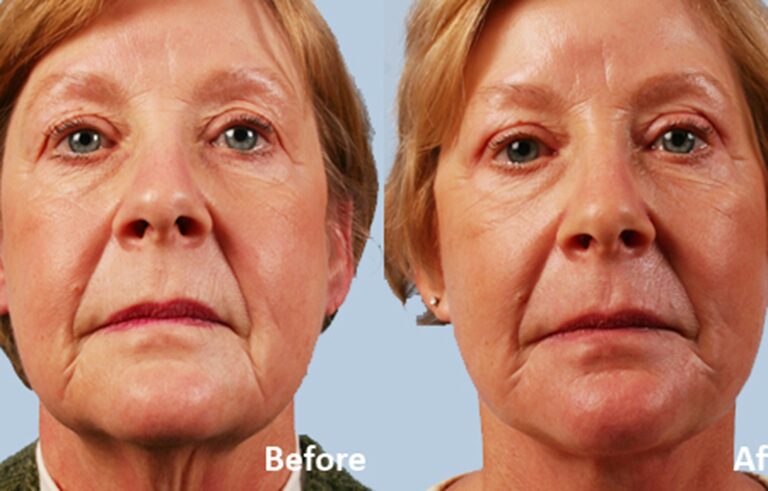 Facelift before and after photo by Midwest Facial Plastic Surgery in Minnesota