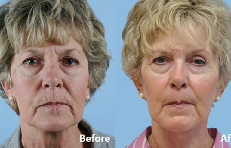 Facelift before and after photo by Midwest Facial Plastic Surgery in Minnesota