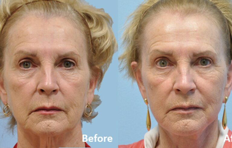 Facelift before and after photo by Midwest Facial Plastic Surgery in Minnesota