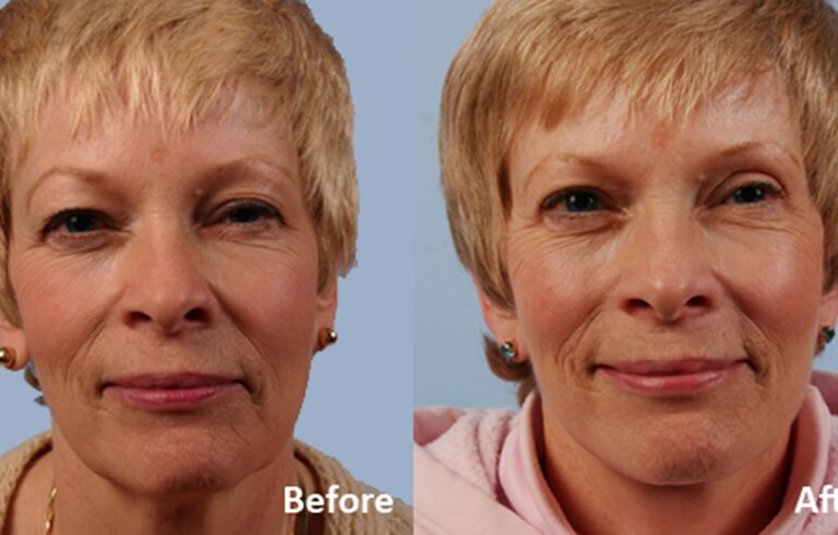 Facelift before and after photo by Midwest Facial Plastic Surgery in Minnesota