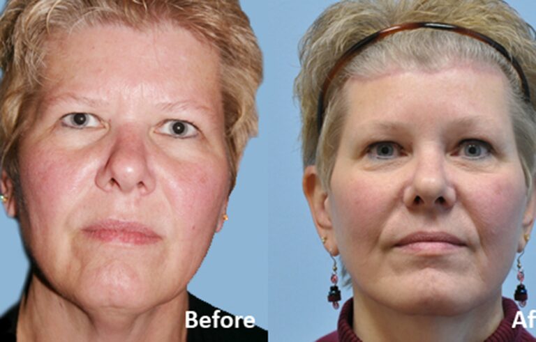 Facelift before and after photo by Midwest Facial Plastic Surgery in Minnesota