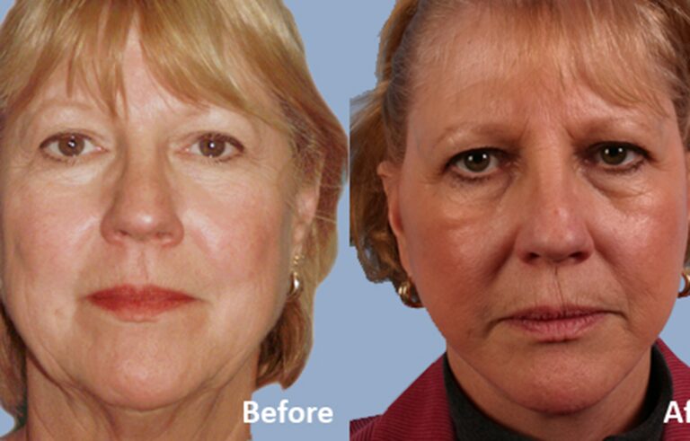 Facelift before and after photo by Midwest Facial Plastic Surgery in Minnesota