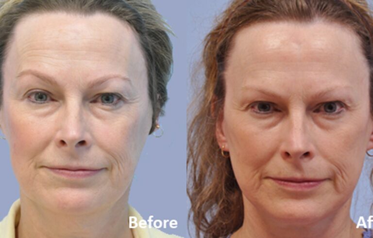 Facelift before and after photo by Midwest Facial Plastic Surgery in Minnesota